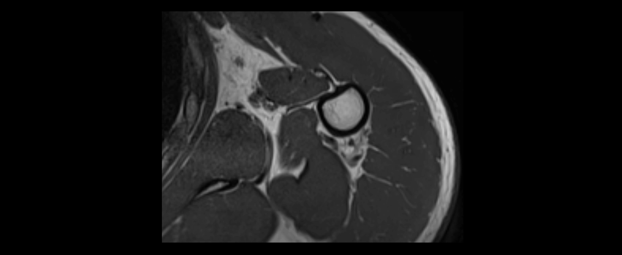 shoulder ligaments axial 3d 3t mri image-img-00005-00106.webp